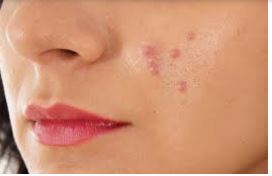 Skin Care Tips : चेहरे के दाग धब्बों को करें ऐसे करें दूर, जानिए आसान घरेलू टिप्स