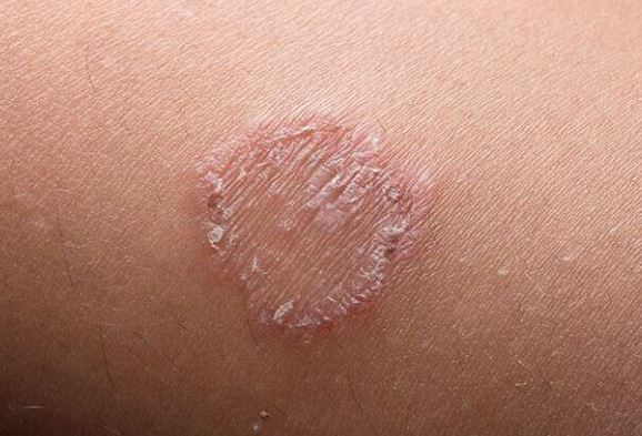 Skin Problem:लोगों में त्वचा से जुड़ी समस्या आम हो गई है, इसके बचाव के बारे में जानिए