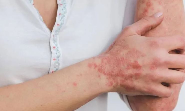 skin rash : स्किन पर लाल चकत्ते को झट से दूर करें ये घरेलू इलाज, इस मौसम में है बहुत ही उपयोगी