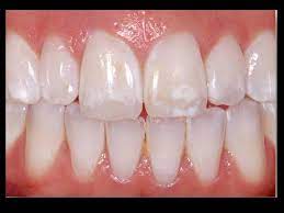 क्या आपके दांतों पर सफेद धब्बे हैं यहां जानिए इसके कारण और उपाय