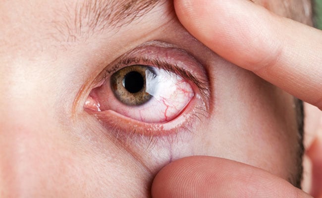 जानिए रेटिनोब्लास्टोमा या आंख का कैंसर क्या है