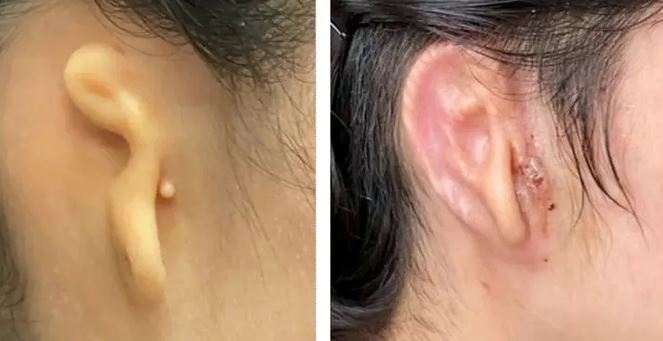 3D Printed Ears : दुनिया में पहली बार, महिला को अपनी कोशिकाओं से बना 3डी प्रिंटेड कान मिला