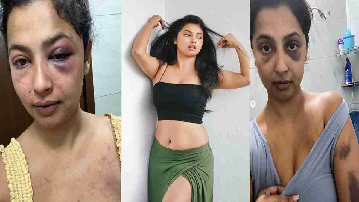 मुझे बहुत बुरी तरह मारा उसने, शरीर के घाव दिखा कर बोली एक्ट्रेस
